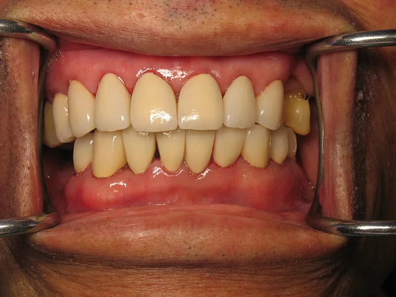 After Porcelain Veneers treatment