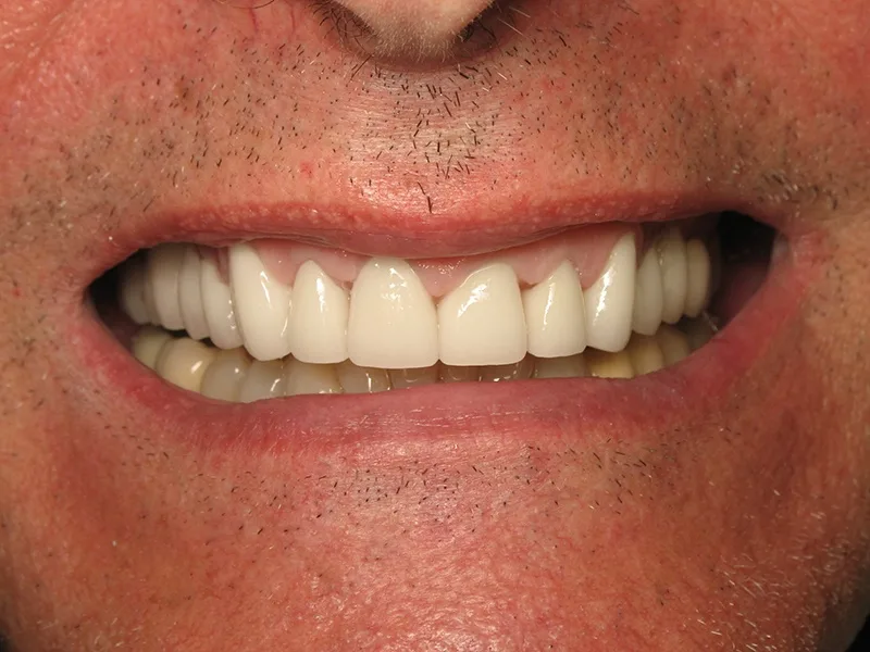 After Dental Implants treatment
