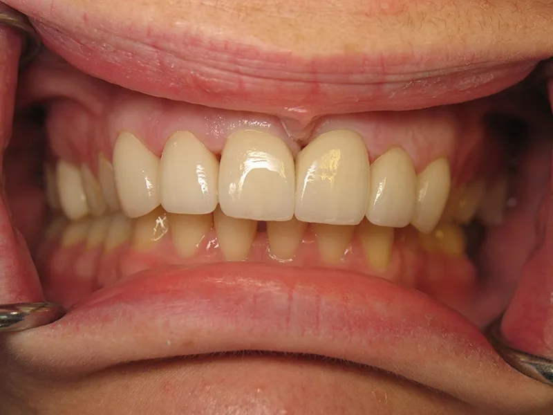 After Dental Crowns treatment