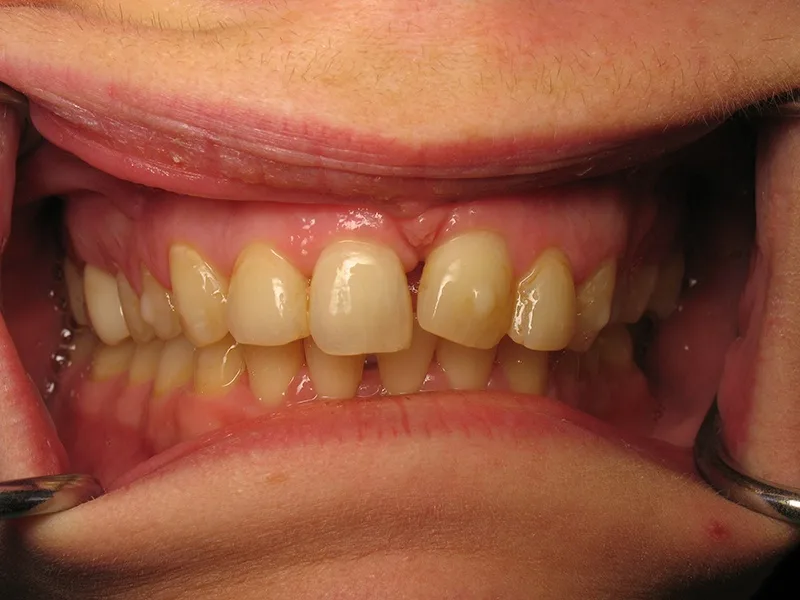Before Dental Crowns treatment
