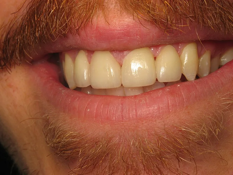 After Full Restoration treatment