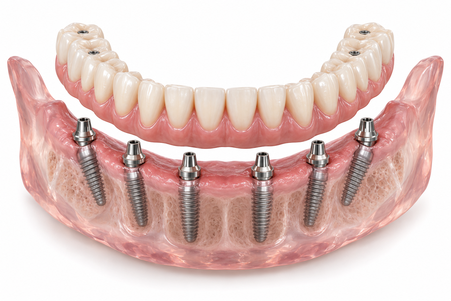 Full-arch implant-supported prosthesis with six titanium implants in a transparent mandible model