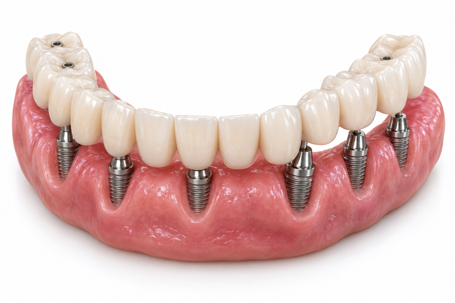 3D render of a full-arch implant-supported bridge with six titanium implants in pink gum tissue