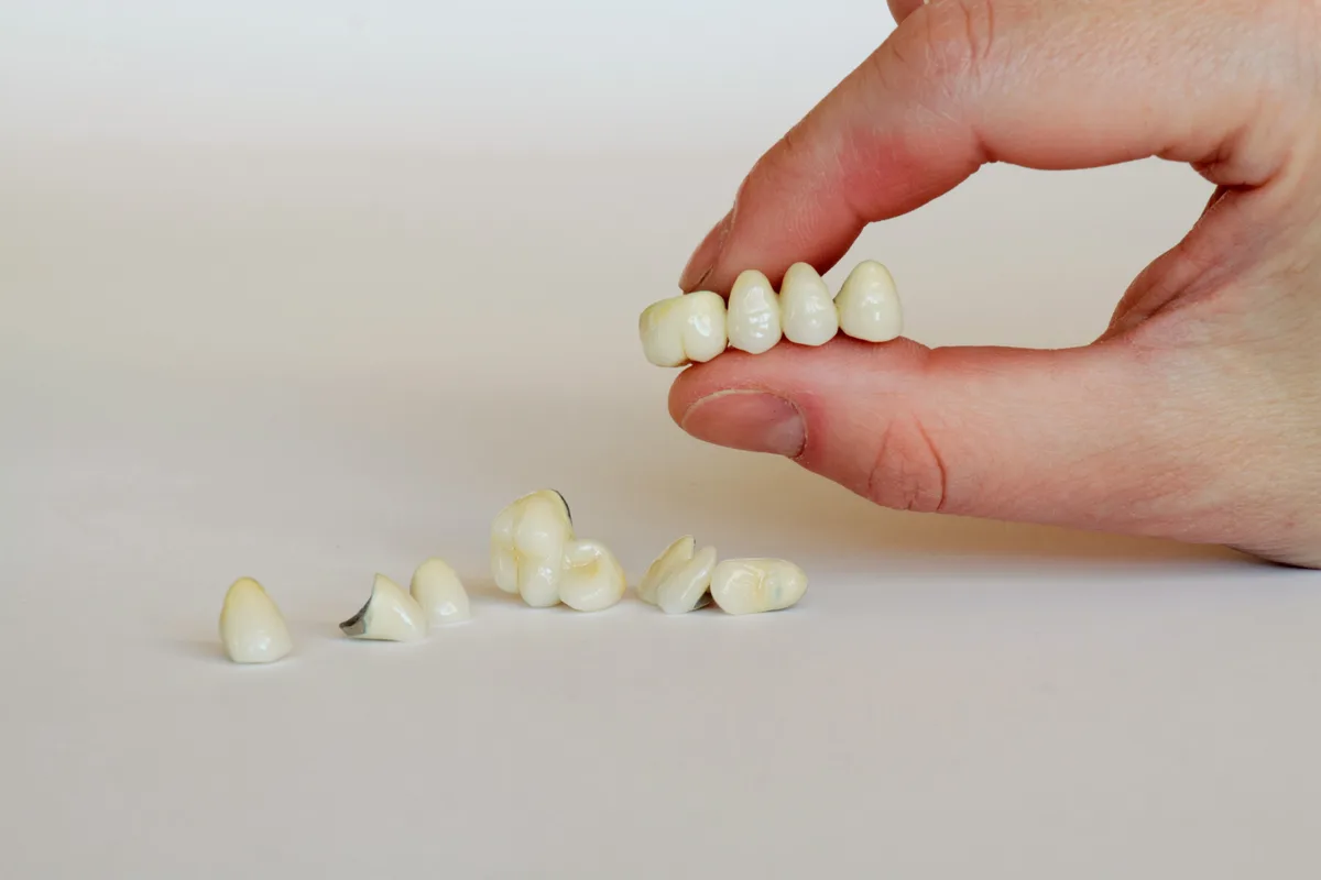 Custom porcelain dental crowns and bridge work crafted at our Simi Valley office