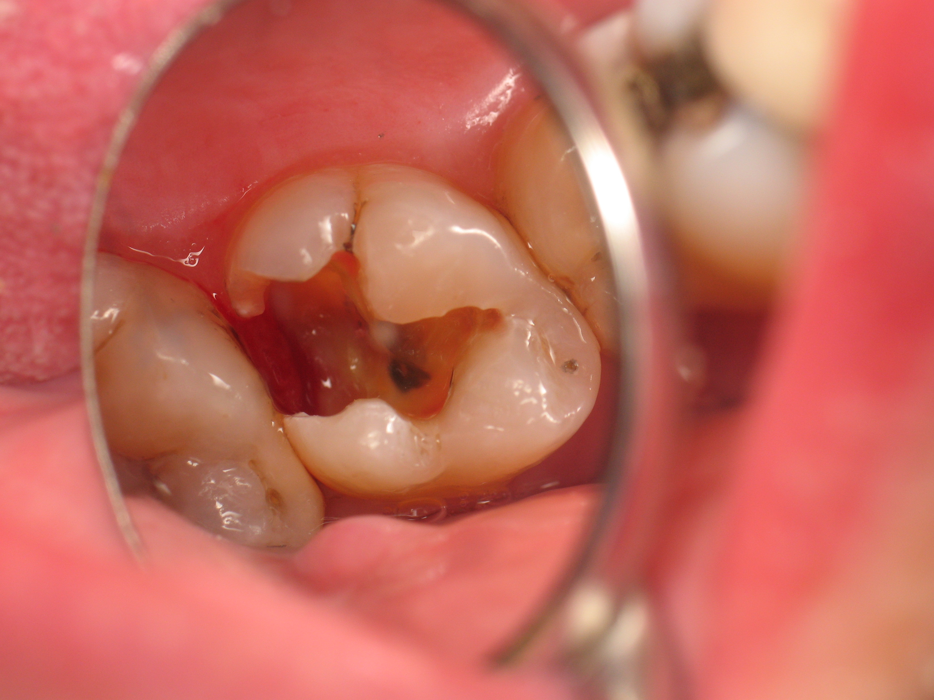 Close-up intraoral view of a molar with an old amalgam filling through a dental mirror