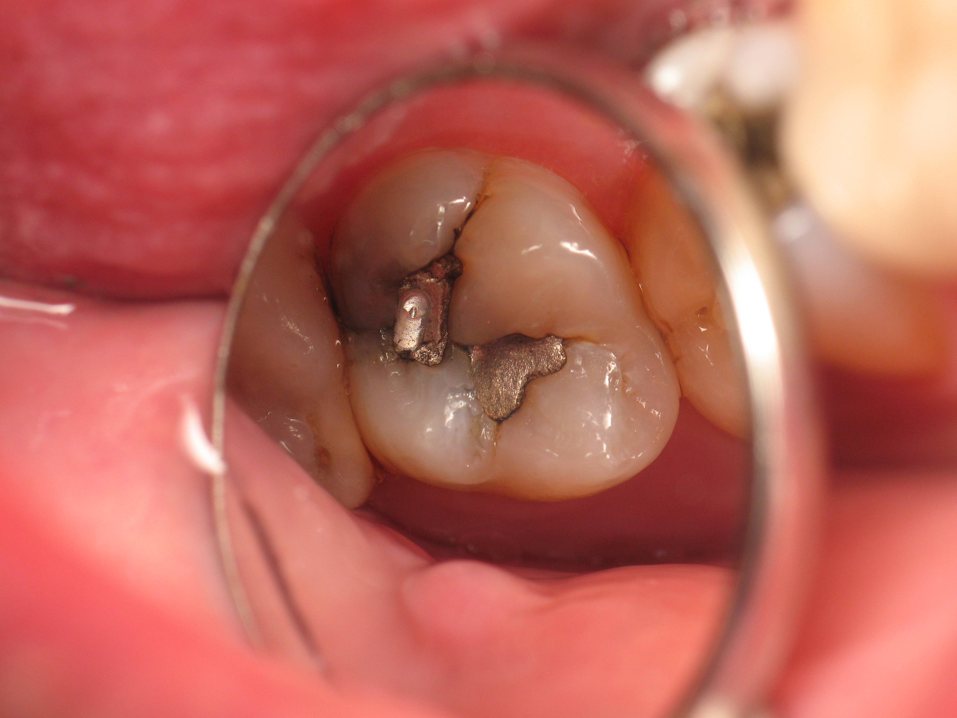 Close-up intraoral view of a molar with visible decay through a dental mirror