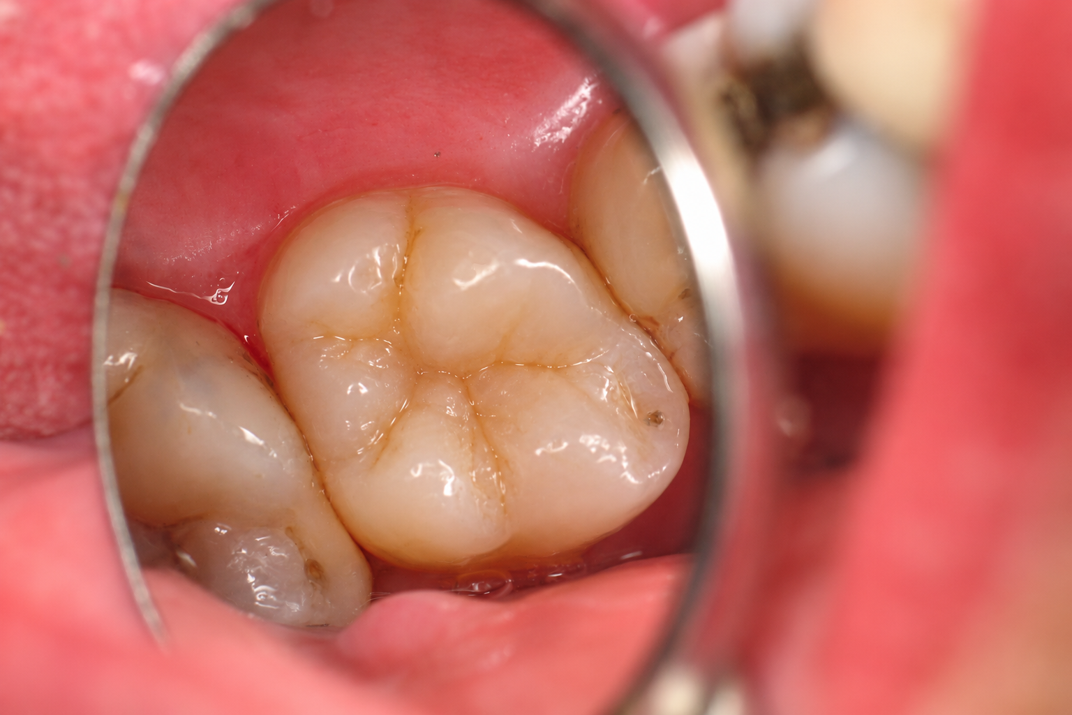 After: same molar restored with a natural white composite filling